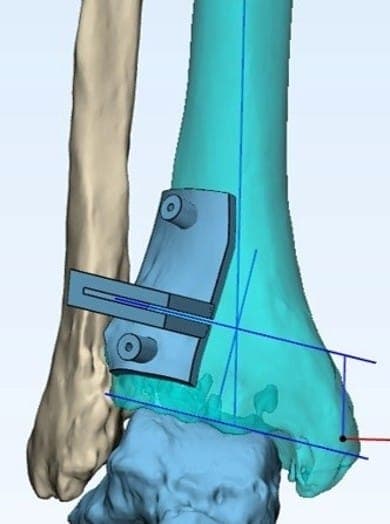 Patient-Specific Surgical Guides