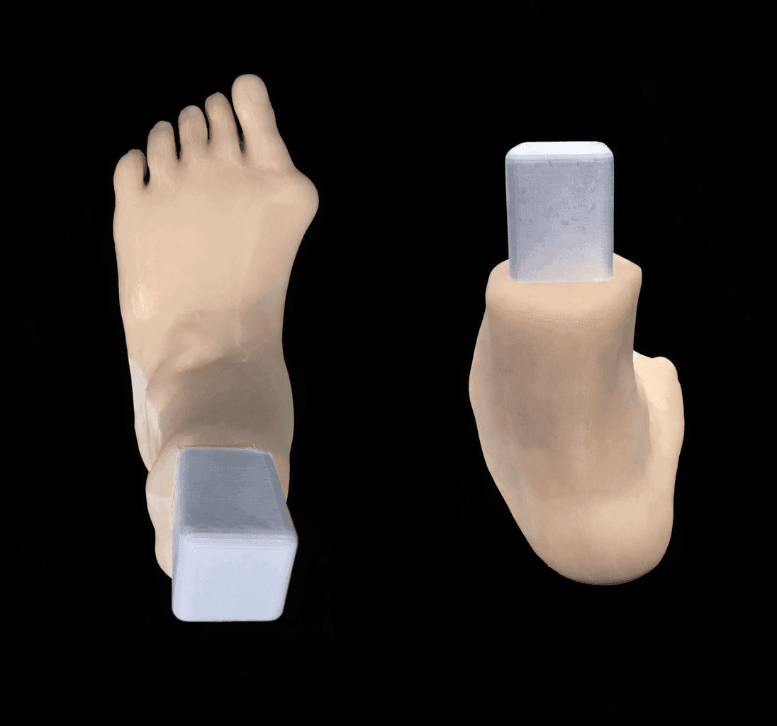 2 Pathology in 1 Foot – Hallux Valgus & Pes Planus – Radioopaque Bone – Opaque Skin – Mobile Joints