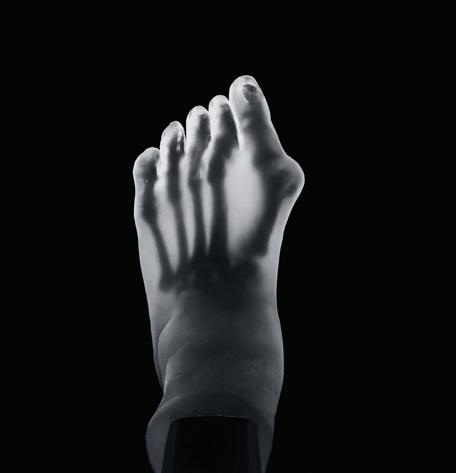 2 Pathology in 1 Foot – Hallux Valgus & Pes Planus – Transparent Skin – Radiolucent Bone – Mobile Joints