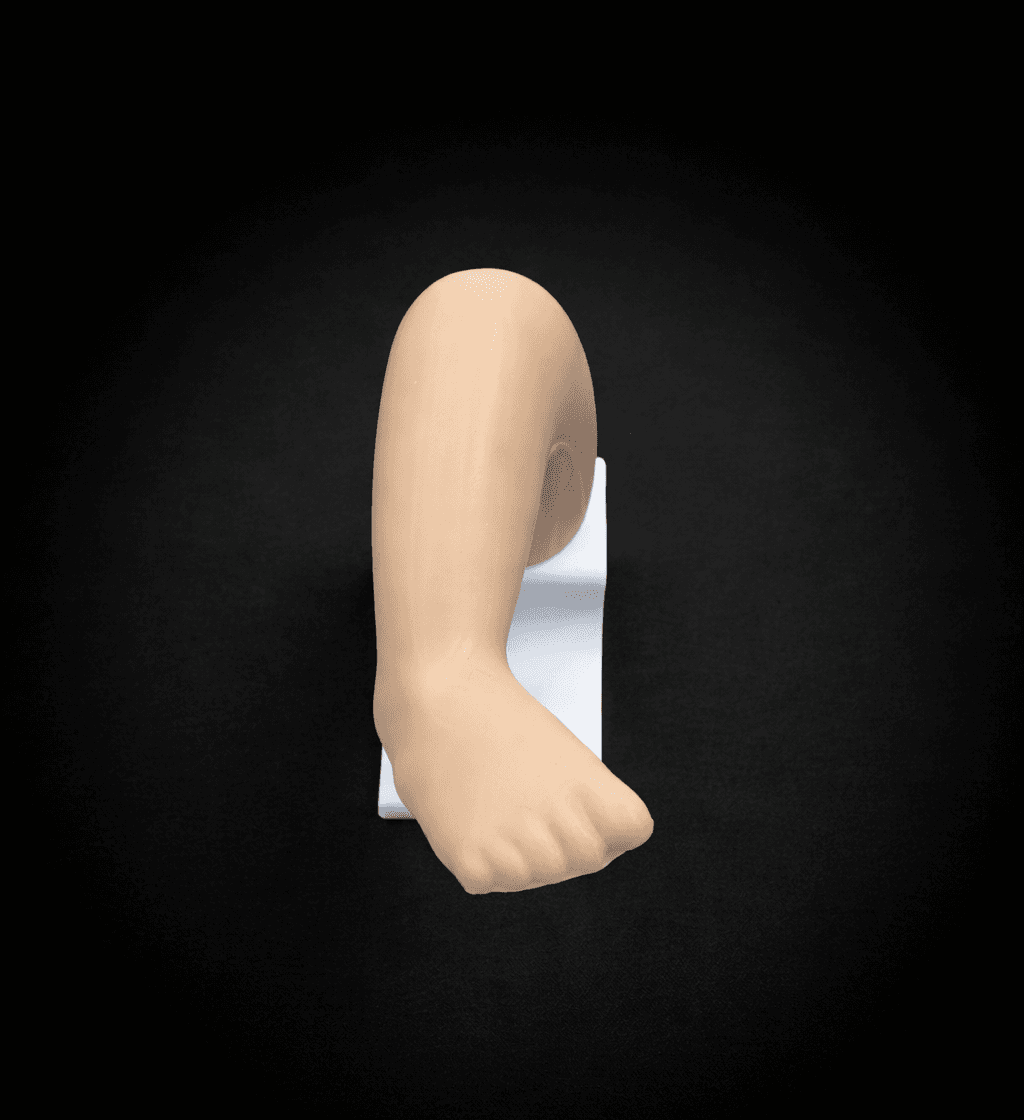 Club Foot (Pes Equinovarus) – Partially Corrected