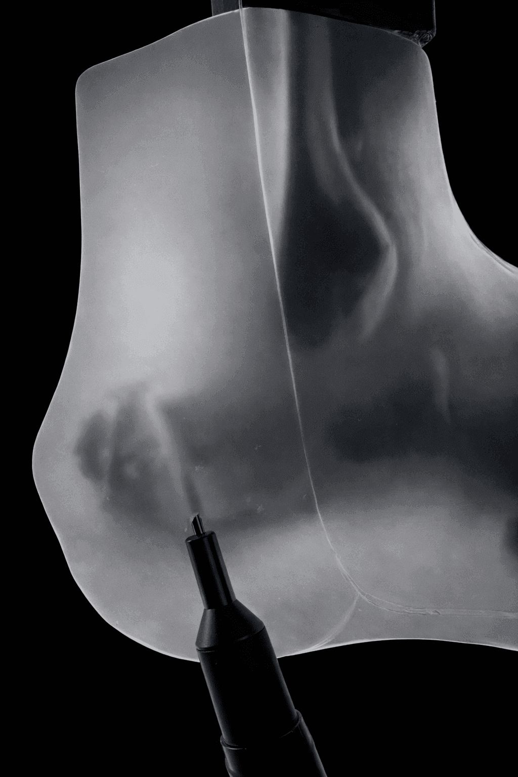 Haglund Deformity & Insertional Achilles Tendinopathy – Transparent Skin – Radiolucent Black Bone