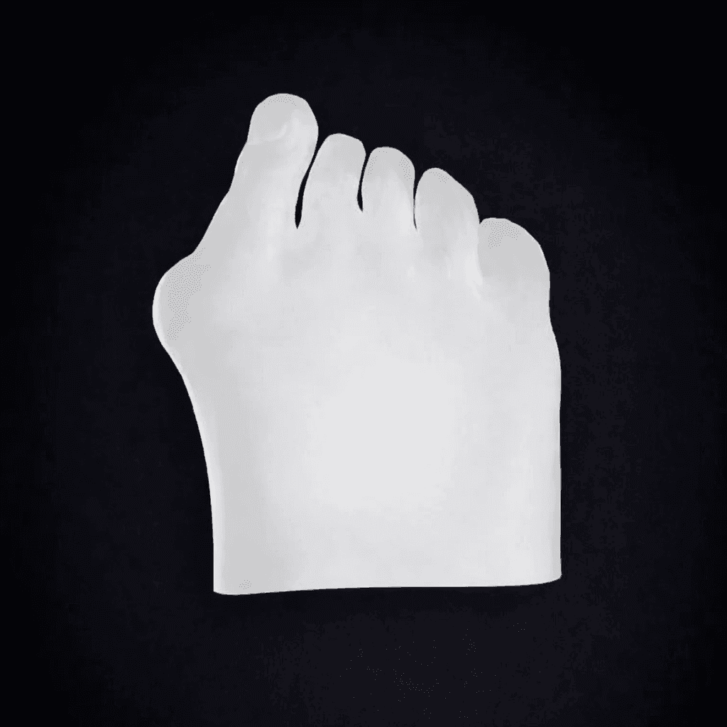 Modular Skin Part Compatible with Hallux Valgus Bone Model (Transparent)