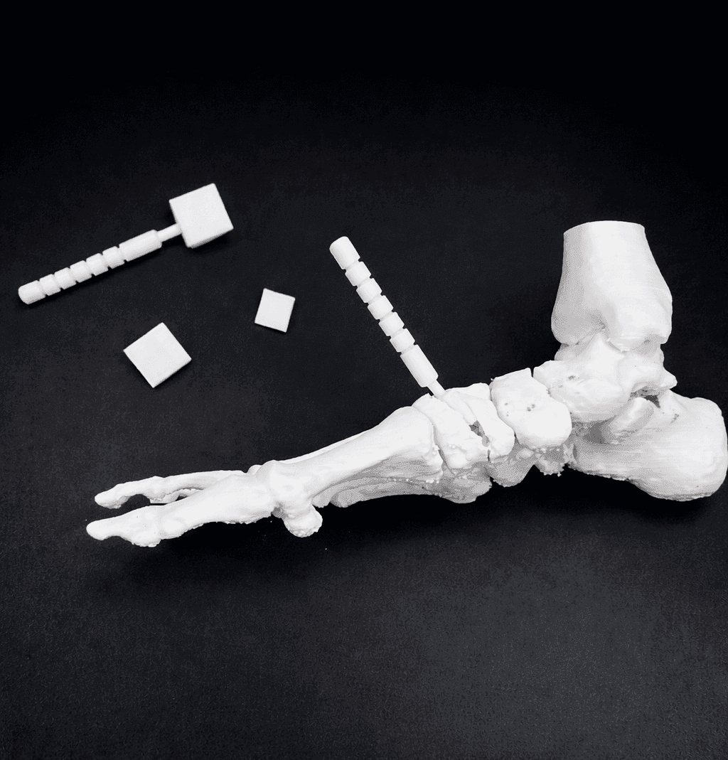 Pes Planus – Bone Model – Mobile Tarsal Joints (including Evans & Cotton wedges)